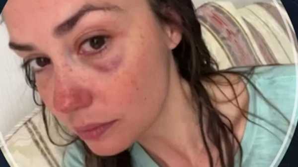 "Заехала мне ремнем": Агата Муцениеце призналась, от кого получила синяк под глазом